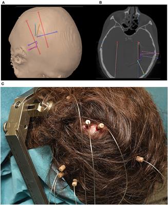 The Potential of Stereotactic-EEG for Brain-Computer Interfaces: Current Progress and Future Directions